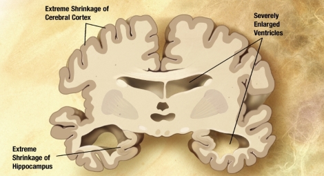 Alzheimer’s can be transmitted from one person to another – new evidence